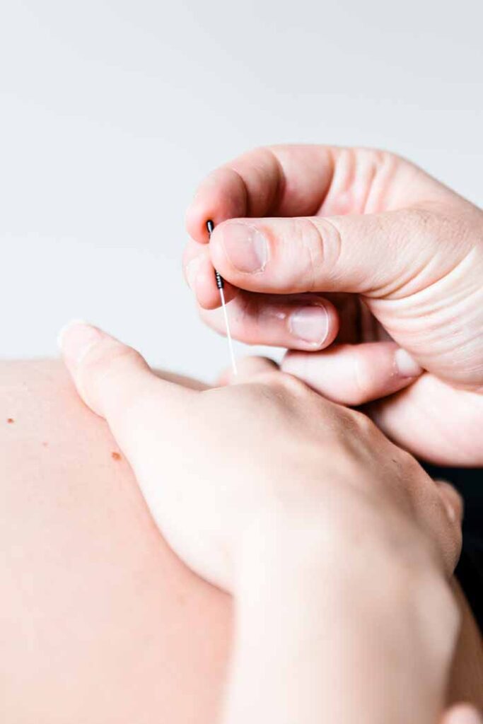 gravid-akupunktur